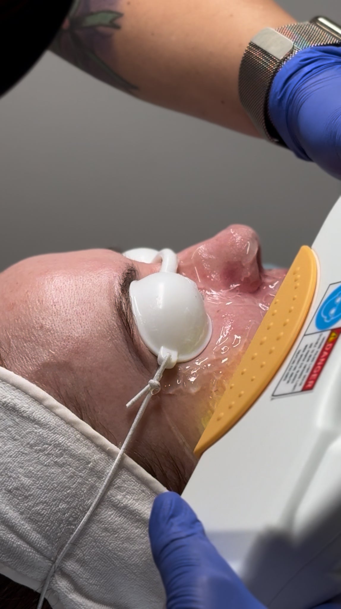 IPL Photo Rejuvenation