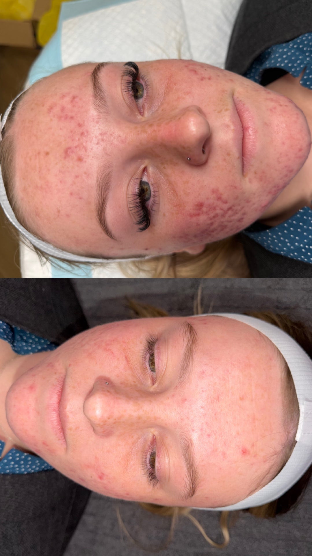 Client skin before and after treatment